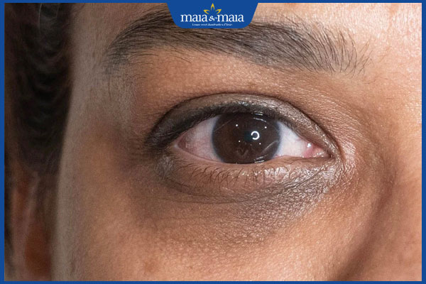 quầng thâm sắc tố