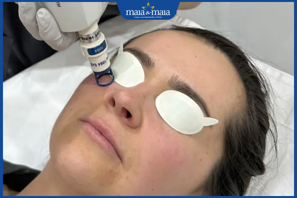 quy trình bắn laser thâm mắt