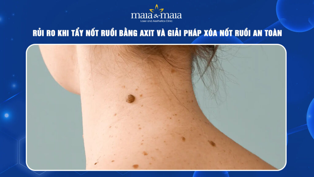 Tẩy nốt ruồi bằng axit