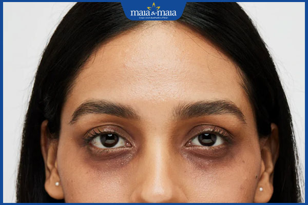 thâm đen ở quầng mắt