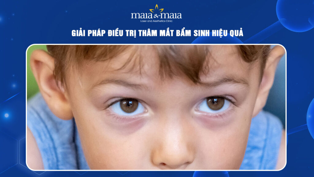 Giải pháp điều trị thâm mắt bẩm sinh hiệu quả 1 Thâm mắt bẩm sinh