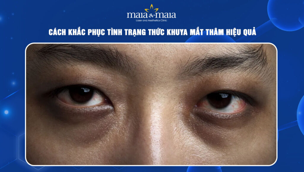 Cách khắc phục tình trạng thức khuya mắt thâm hiệu quả 1 thức khuya mắt thâm