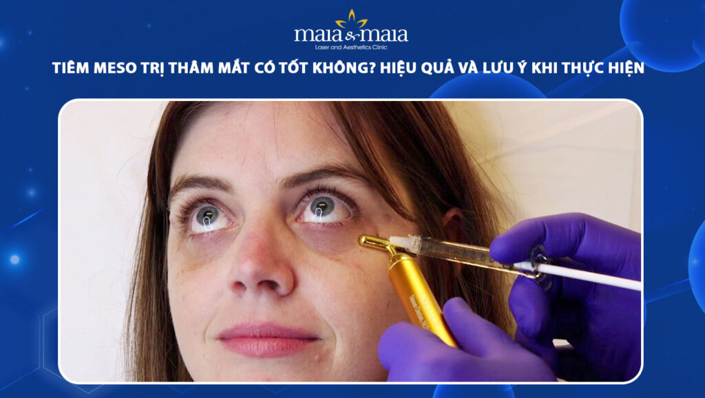 Tiêm meso trị thâm mắt có tốt không? Hiệu quả và lưu ý 1 tiêm meso trị thâm mắt