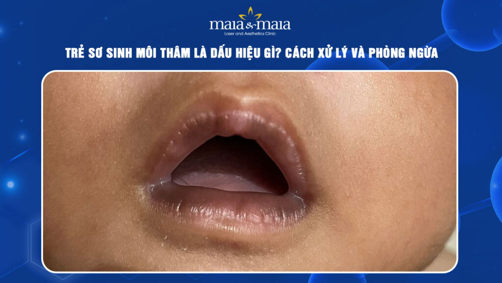 trẻ sơ sinh môi thâm