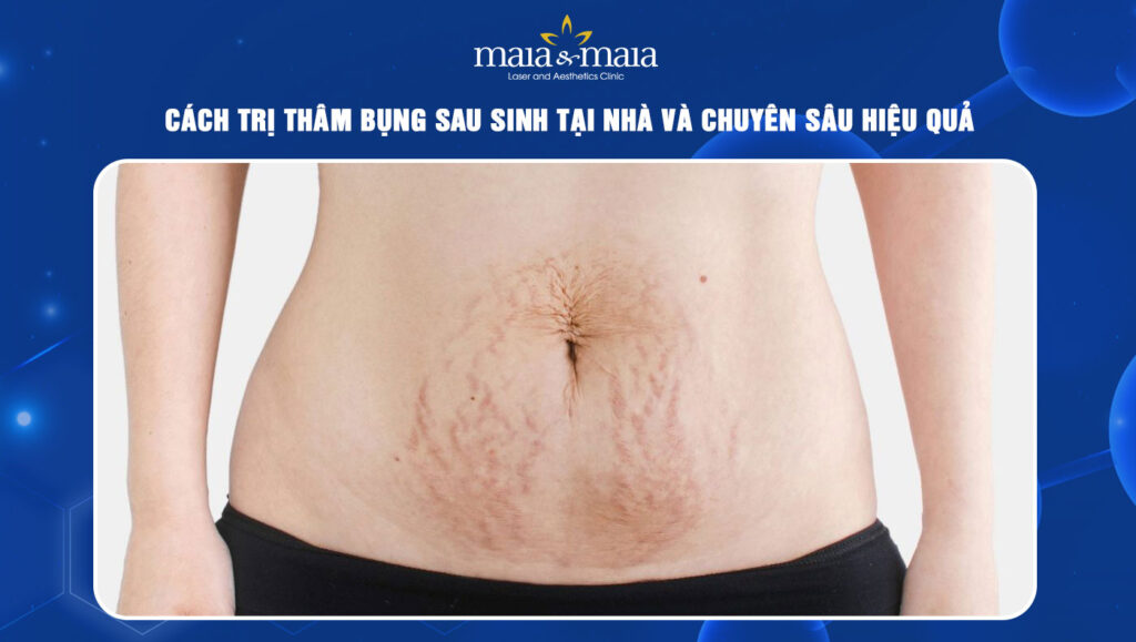 trị thâm bụng sau sinh