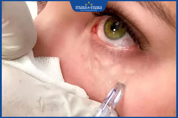 Tiêm meso trị thâm mắt có tốt không? Hiệu quả và lưu ý 2 trị thâm mắt bằng meso