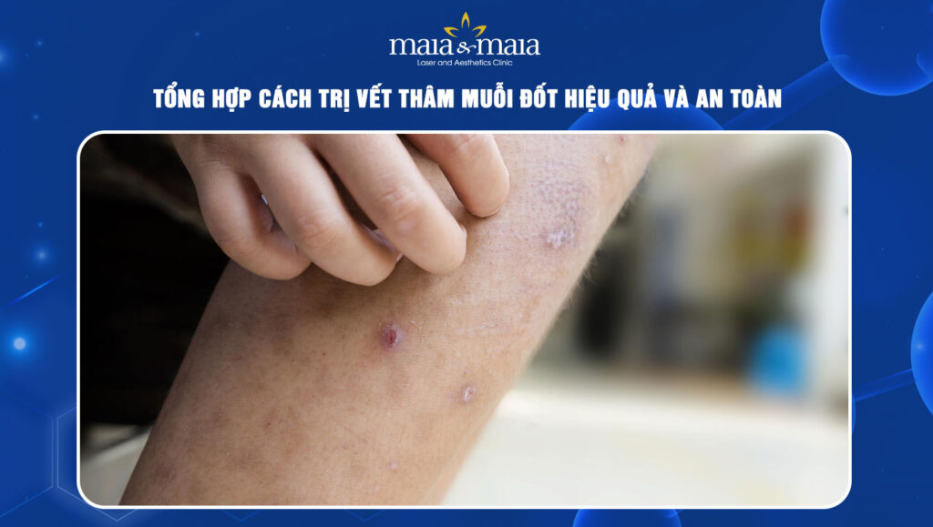 Tổng hợp các cách trị vết thâm muỗi đốt hiệu quả và an toàn 1 trị vết thâm muỗi đốt
