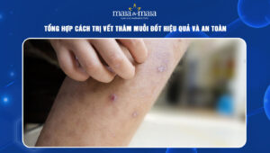 trị vết thâm muỗi đốt