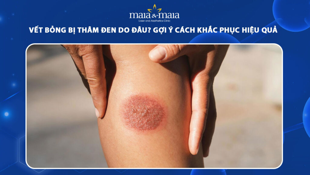 Giải pháp tân tiến xóa vết bỏng bị thâm đen hiệu quả cao 1 vết bỏng bị thâm đen