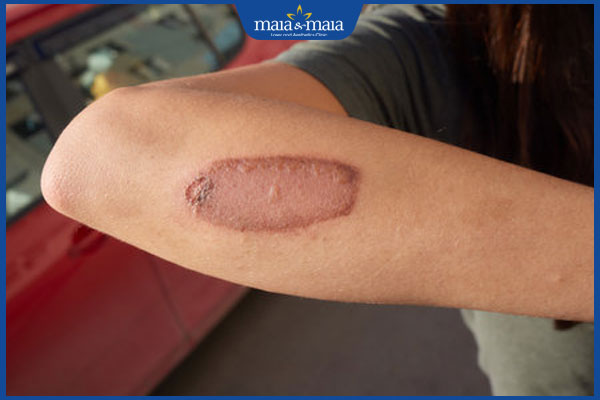 Giải pháp tân tiến xóa vết bỏng bị thâm đen hiệu quả cao 2 vết bỏng bị thâm