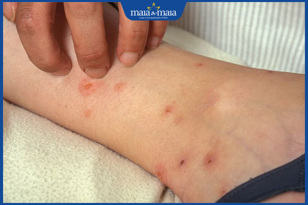 Cách điều trị vết thâm do côn trùng cắn và tips phòng ngừa 2 vết côn trùng cắn