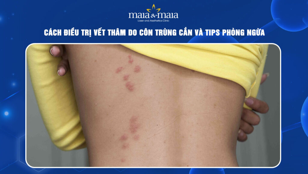Cách điều trị vết thâm do côn trùng cắn và tips phòng ngừa 1 vết thâm do côn trùng cắn