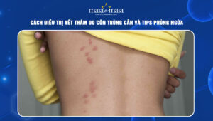 vết thâm do côn trùng cắn