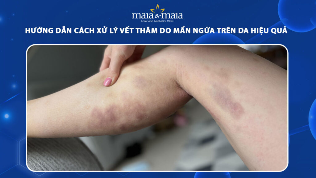Hướng dẫn cách xử lý vết thâm do mẩn ngứa trên da hiệu quả 1 vết thâm do mẩn ngứa trên da