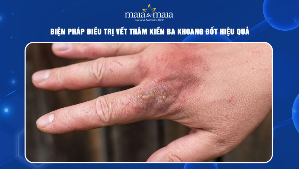 Vết thâm kiến ba khoang phải làm sao? Giải pháp hiệu quả 1 vết thâm kiến ba khoang