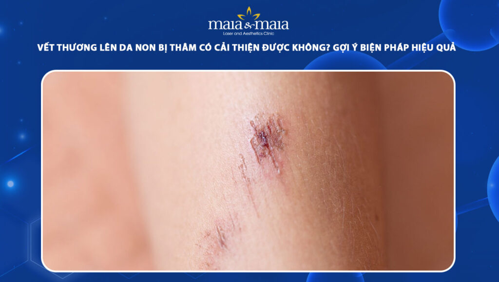 Vết thương lên da non bị thâm có cải thiển được không? 1 vết thương lên da non bị thâm