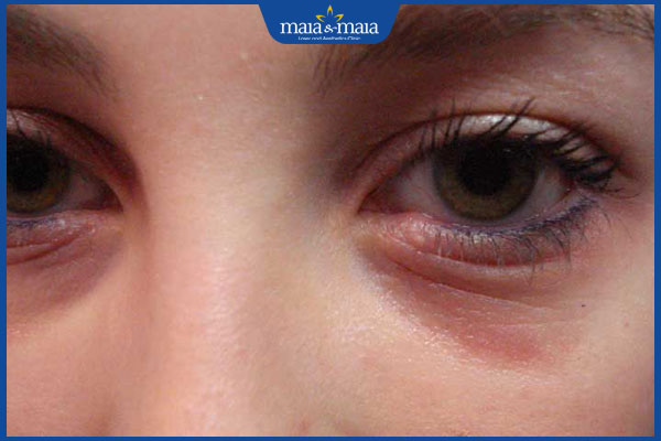 viêm mũi dị ứng khiến mắt thâm