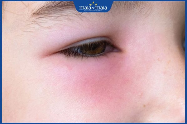 Trị thâm mắt bằng mỡ trăn hiệu quả không? Lưu ý cần biết 3 vùng mắt kích ứng