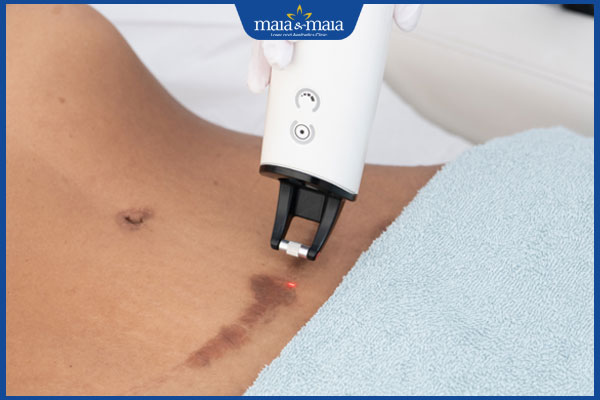 Cách điều trị thâm bẹn hiệu quả nhanh chóng và an toàn 4 xóa thâm bằng laser