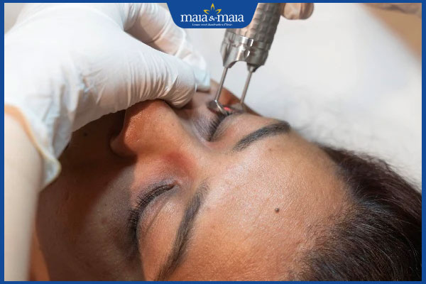 xóa thâm mắt bằng laser