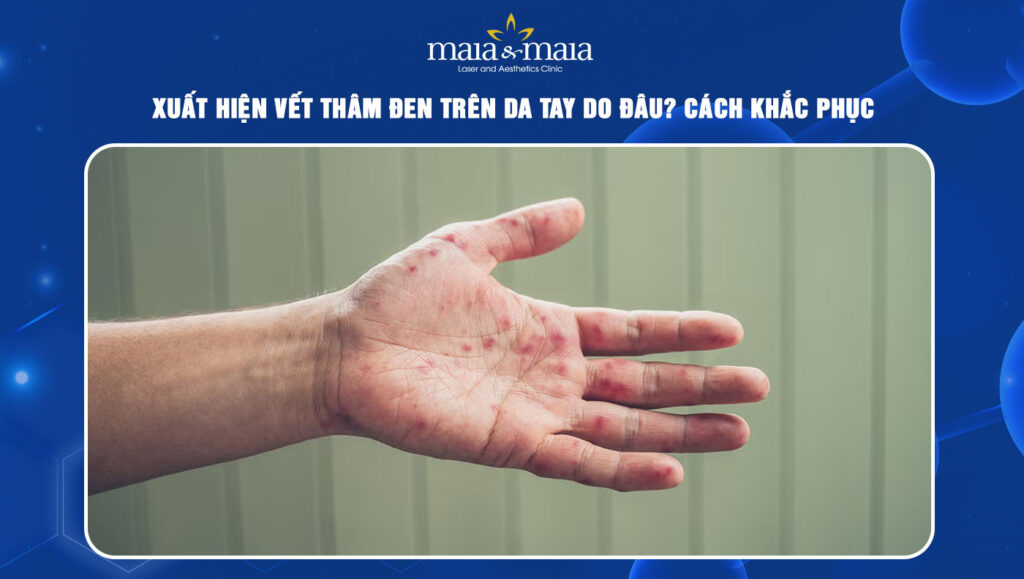 xuất hiện vết thâm đen trên da tay