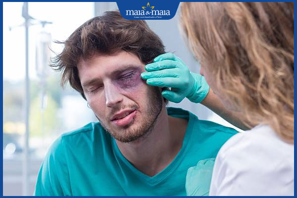 bầm tím ở mắt khám bác sĩ