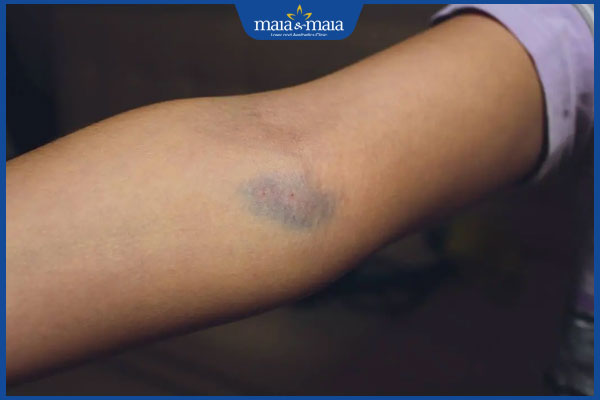 bầm tím trên tay