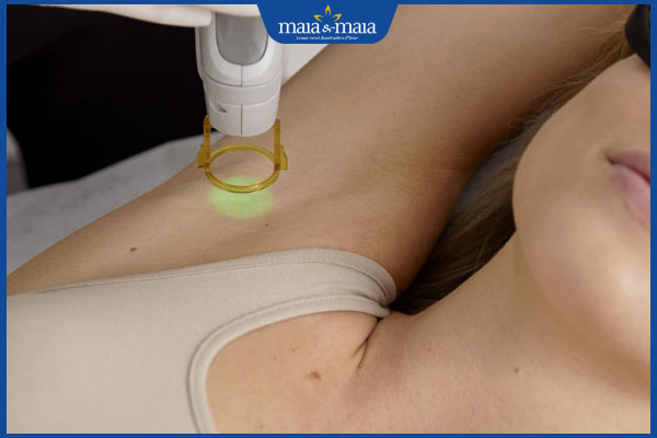 Thâm nách: Nguyên nhân, cách khắc phục và phòng ngừa hiệu 4 bắn laser trị thâm nách