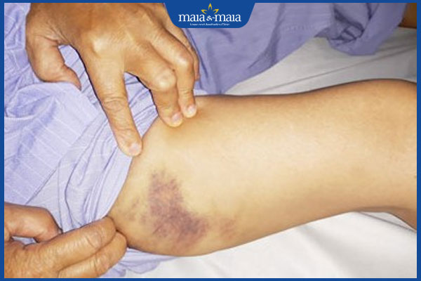 bệnh rối loạn đông máu