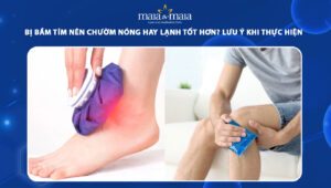 bị bầm tím nên chườm nóng hay lạnh