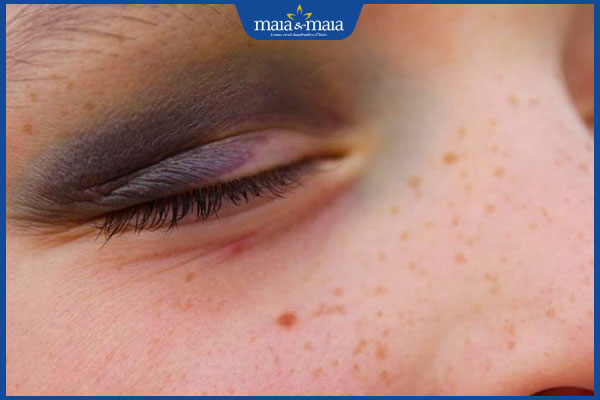 Hướng dẫn làm tan vết bầm tím ở mắt an toàn, nhanh chóng 2 bị bầm tím ở mắt