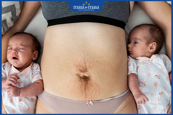 Thâm bụng sau sinh: Cách khắc phục và phòng tránh hiệu quả 2 bị thâm bụng sau sinh