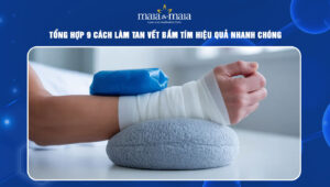 cách làm tan vết bầm tím