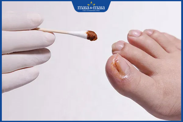 Móng chân bị bầm tím do đâu? Có nguy hiểm không? 5 chăm sóc móng chân