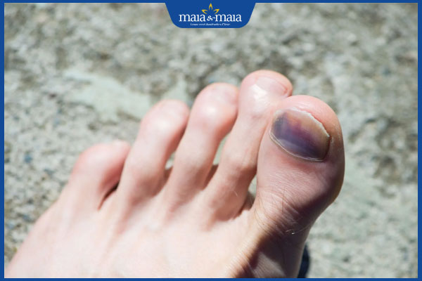 Móng chân bị bầm tím do đâu? Có nguy hiểm không? 3 chấn thương ở móng chân