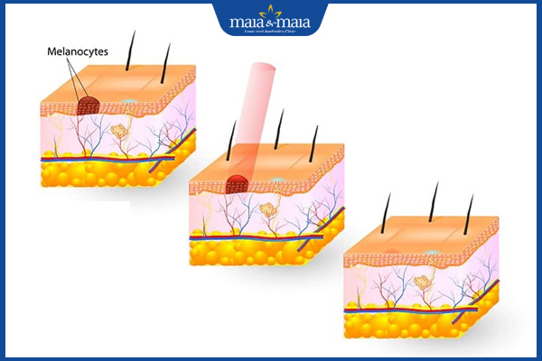 cơ chế laser xóa thâm