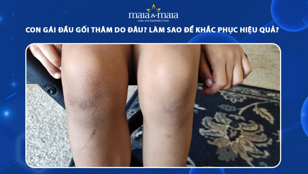 Con gái đầu gối thâm do đâu? Làm sao để khắc phục hiệu quả? 1 con gái đầu gối thâm