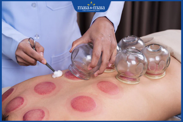 Vết bầm tím khi giác hơi bao lâu tan? Cách xử lý hiệu quả 2 giác hơi bầm tím