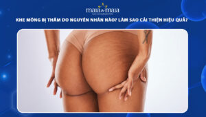 khe mông bị thâm