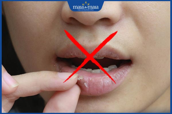 Khử thâm môi bằng laser có hiệu quả không? Ai nên thực hiện? 5 không bóc môi