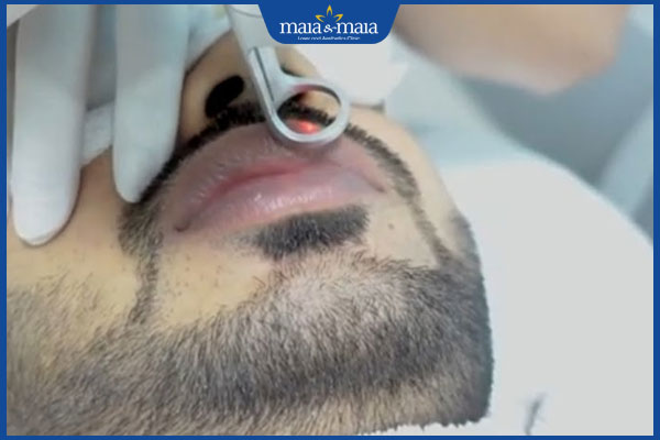 khử thâm môi cho nam giới