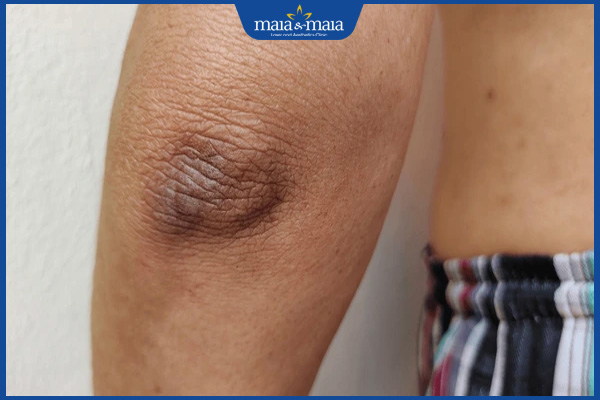 khuỷu tay thâm đen