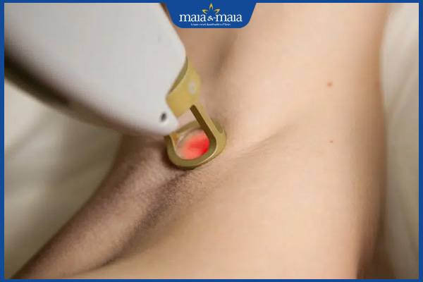 laser xóa thâm nách