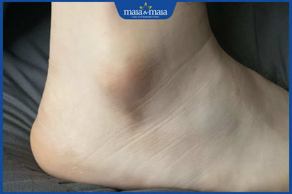 Bật mí các biện pháp xóa thâm mắt cá chân hiệu quả tối ưu hiện nay 2 mắt cá chân bị thâm