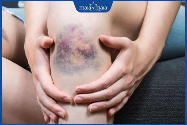 máu bầm dưới da