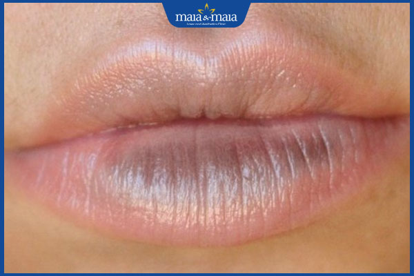 Môi có vết thâm đen tiềm ẩn bệnh lý gì? Có nguy hiểm không? 2 môi bị thâm đen