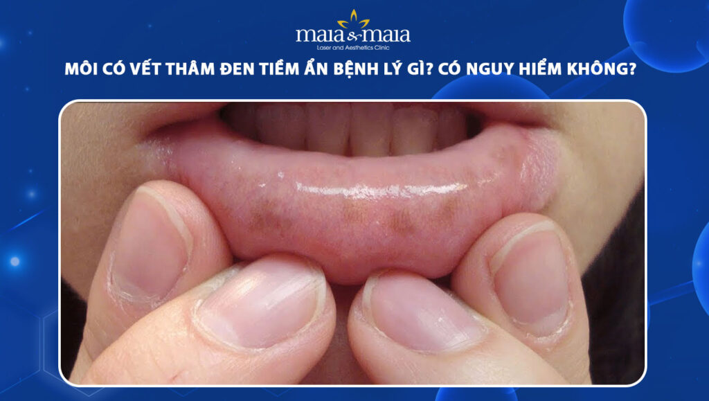 Môi có vết thâm đen tiềm ẩn bệnh lý gì? Có nguy hiểm không? 1 môi có vết thâm đen