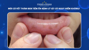 môi có vết thâm đen