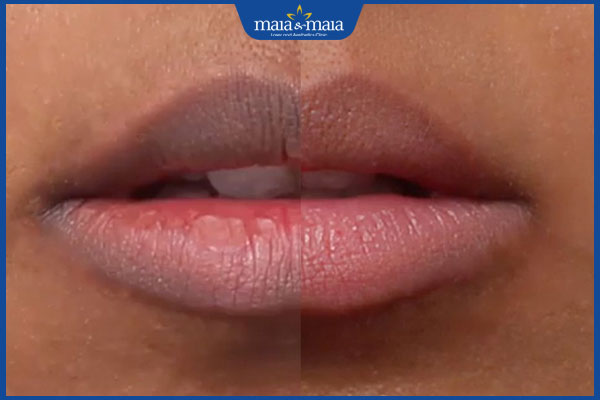 môi sau khử thâm