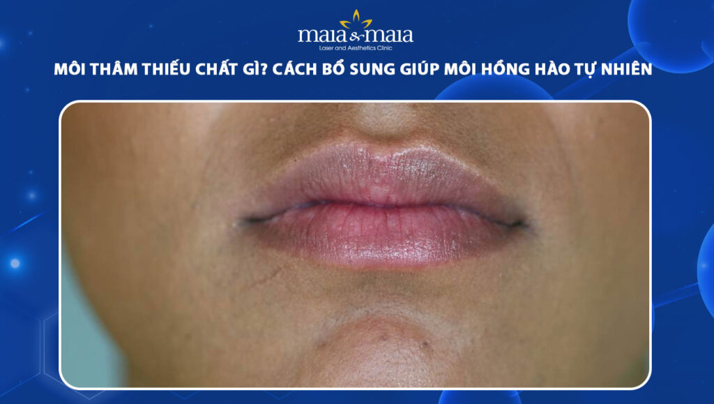 Môi thâm thiếu chất gì? Cách bổ sung dưỡng chất cho môi 1 môi thâm thiếu chất gì